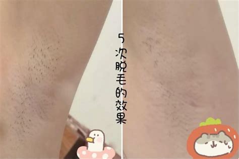 脫毛膏脫腋毛會不會引起狐臭(狐臭怎么解決根除)縮略圖
