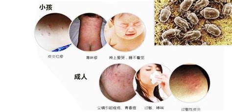被褥有螨蟲怎樣處理(被褥螨蟲怎么去除)縮略圖