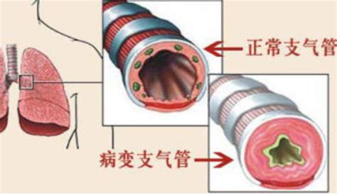 氣管炎(氣管炎的癥狀和表現(xiàn))縮略圖