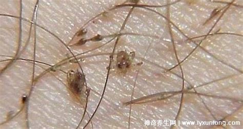 被褥上的陰虱怎么去除,陰虱蓋過的被子會(huì)傳染嗎縮略圖