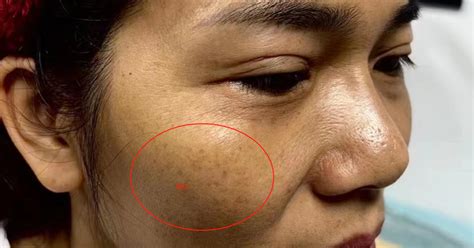 祛斑最好的方法 目前最有效的不反彈,祛斑最好的方法 目前最有效的不反彈不留疤縮略圖