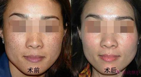 美容院祛斑,美容院祛斑正規方法縮略圖